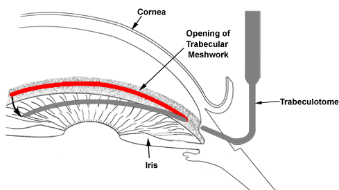 Trabeculectomy